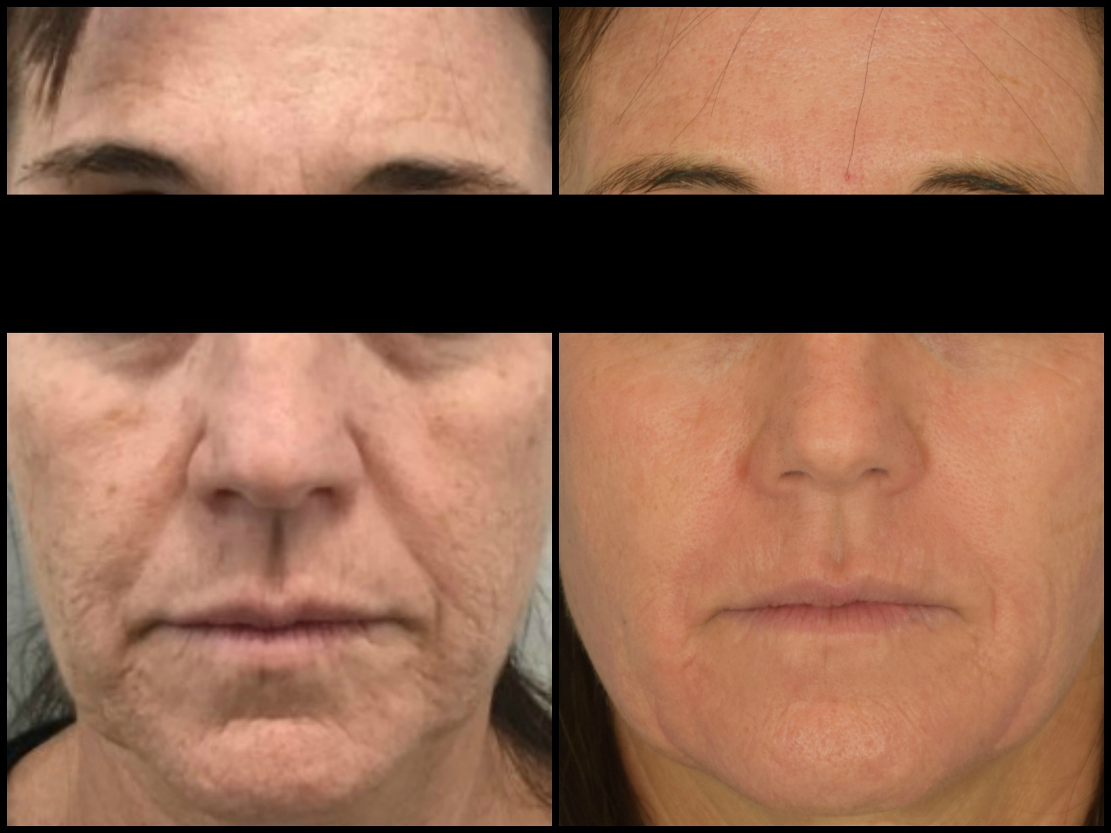 FRACTIONAL CO2 LASER-SKIN-RESURFACING