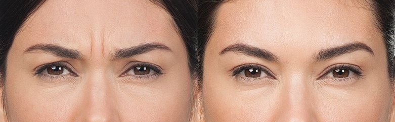 Myths of Botox Debunked Before and After