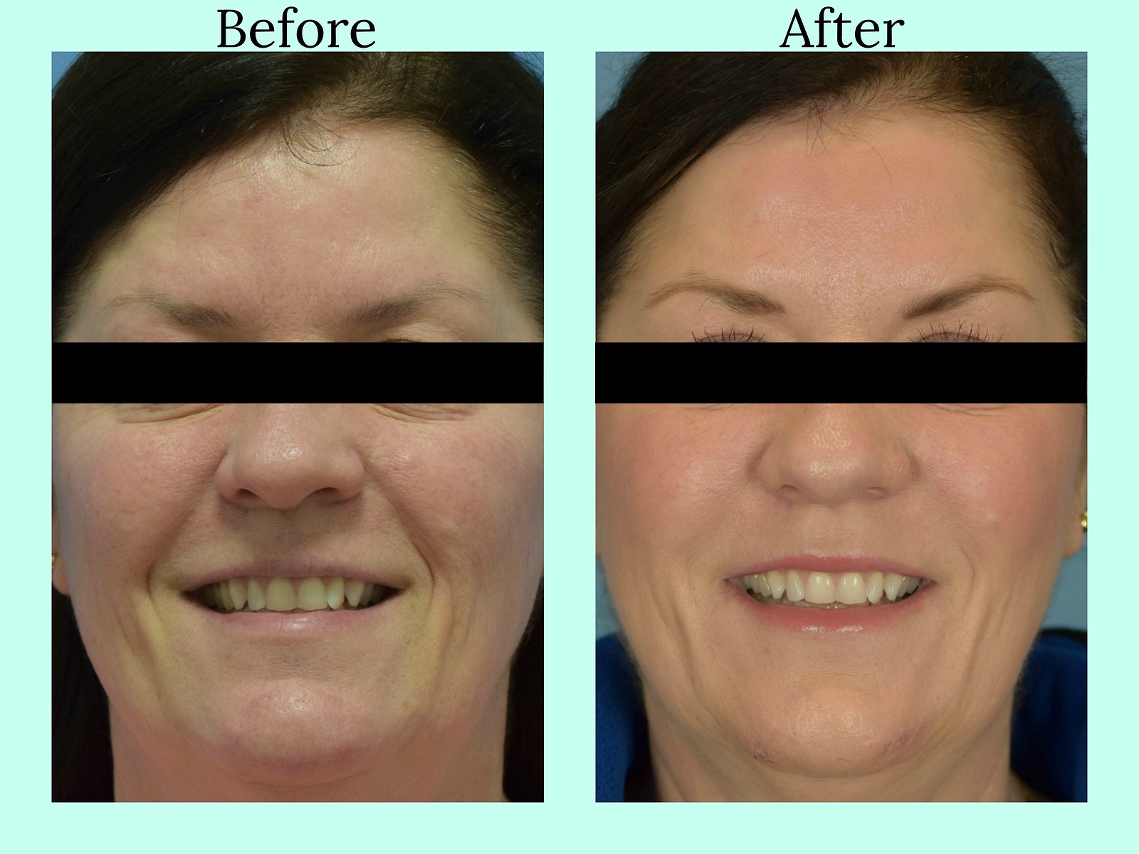 Liquid Facelift Before and After