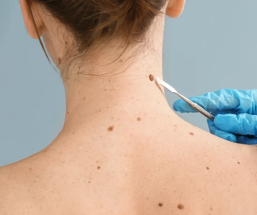 Dermatologist examining a suspicious mole on a patient’s neck during a skin cancer screening evaluation